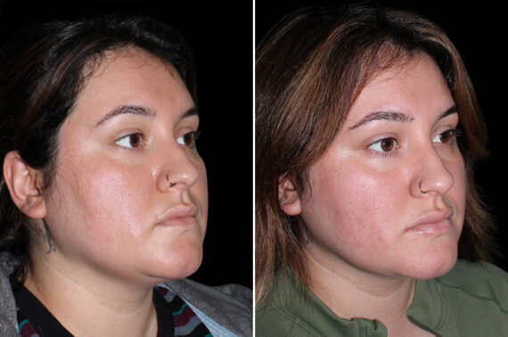 Double Chin Lipo Before and After Photos in CA, Irvine, Patient 3704