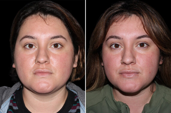 Double Chin Lipo Before and After Photos in CA, Irvine, Patient 3704
