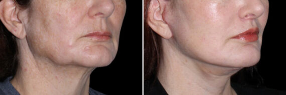 Lip Lift Before and After Photos in CA, Irvine, Patient 3741