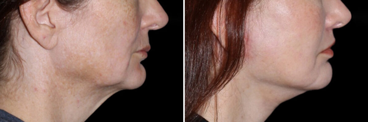 Lip Lift Before and After Photos in CA, Irvine, Patient 3741