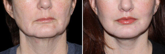 Lip Lift Before and After Photos in CA, Irvine, Patient 3741