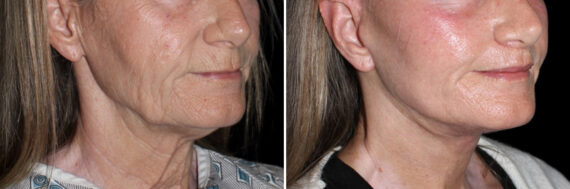 Lip Lift Before and After Photos in CA, Irvine, Patient 3751