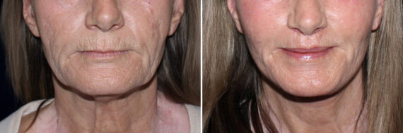 Lip Lift Before and After Photos in CA, Irvine, Patient 3751