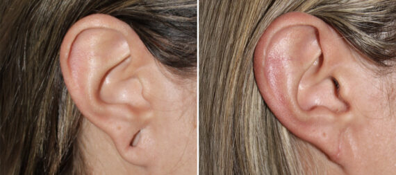 Earlobe Repair Before and After Photos in CA, Irvine, Patient 3771