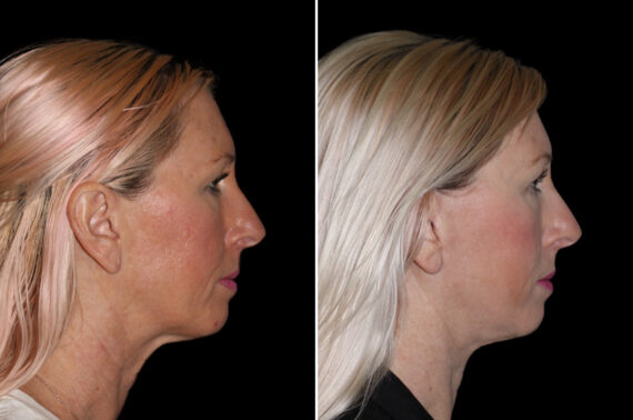Facelift & Necklift Before and After Photos in CA, Irvine, Patient 3694