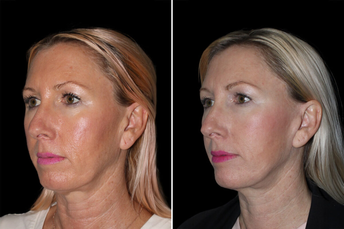 Patient 3694, Facelift & Necklift Before and After Photos Facelift & Necklift Before and After Photos in CA, Irvine, Patient 3694