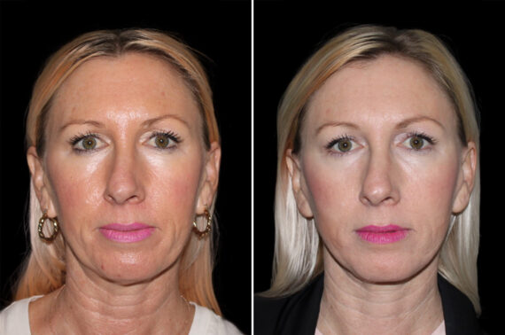 Facelift & Necklift Before and After Photos in CA, Irvine, Patient 3694