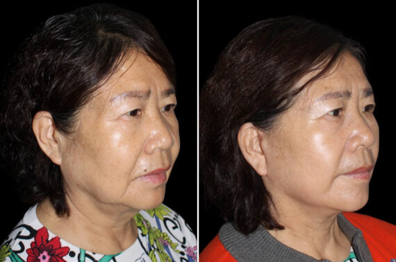 Mini Lift Before and After Photos in CA, Irvine, Patient 3788