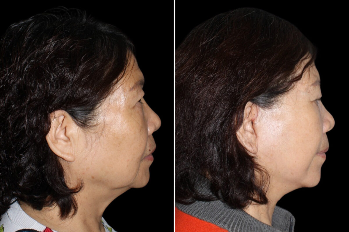 Mini Lift Before and After Photos in CA, Irvine, Patient 3788
