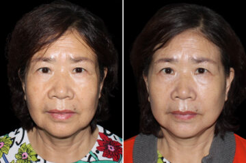 Mini Lift Before and After Photos in CA, Irvine, Patient 3788