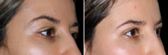 Blepharoplasty Before and After Photos in CA, Irvine, Patient 3807