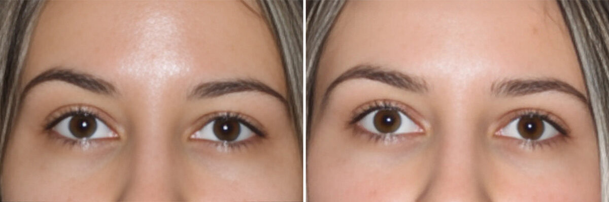 Blepharoplasty Before and After Photos in CA, Irvine, Patient 3807