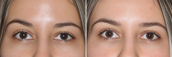 Blepharoplasty Before and After Photos in CA, Irvine, Patient 3807