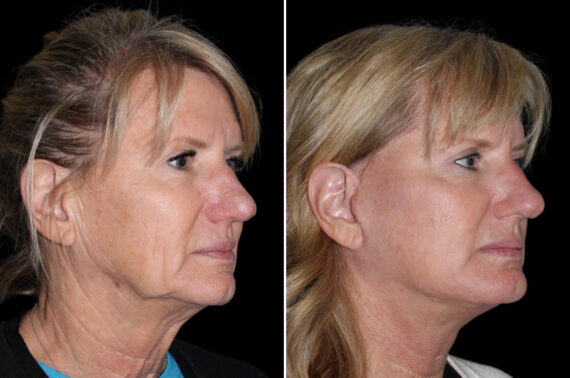 Facelift & Necklift Before and After Photos in CA, Irvine, Patient 3814