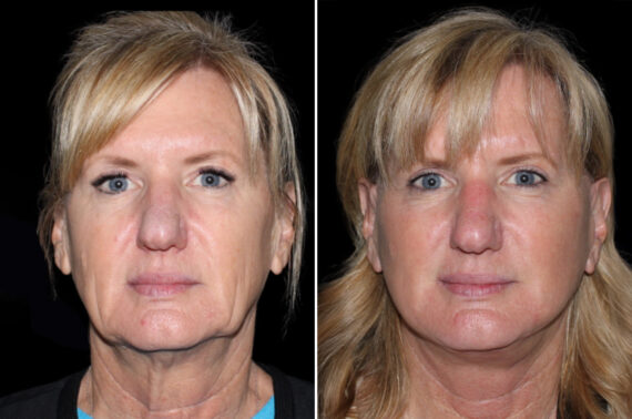 Facelift & Necklift Before and After Photos in CA, Irvine, Patient 3814