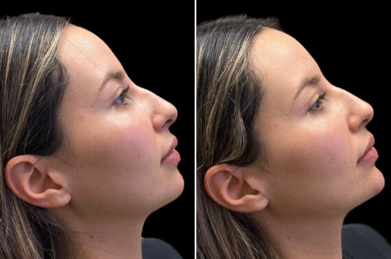 Injectables Before and After Photos in CA, Irvine, Patient 3825