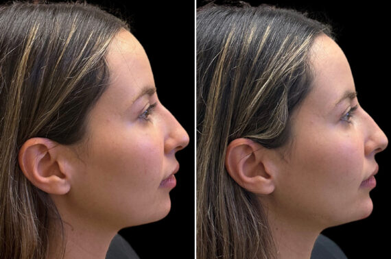 Injectables Before and After Photos in CA, Irvine, Patient 3825
