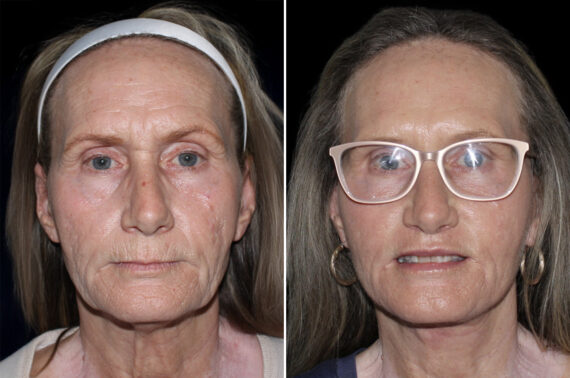 Facelift & Necklift Before and After Photos in CA, Irvine, Patient 3653