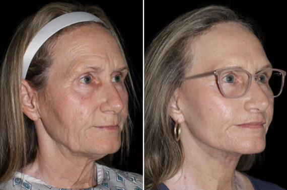 Facelift & Necklift Before and After Photos in CA, Irvine, Patient 3653