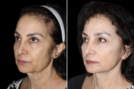 Facelift & Necklift Before and After Photos in CA, Irvine, Patient 3711
