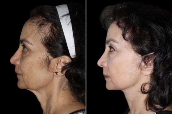 Facelift & Necklift Before and After Photos in CA, Irvine, Patient 3711