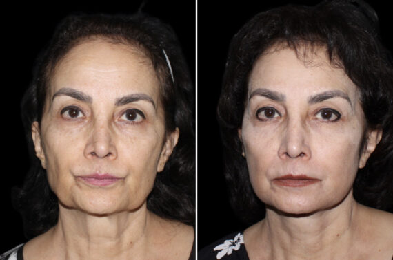 Facelift & Necklift Before and After Photos in CA, Irvine, Patient 3711