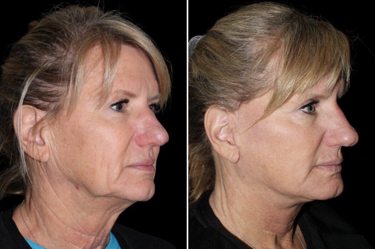 Patient 3814, Facelift & Necklift Before and After Photos Facelift & Necklift Before and After Photos in CA, Irvine, Patient 3814