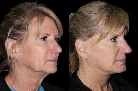 Facelift & Necklift Before and After Photos in CA, Irvine, Patient 3814