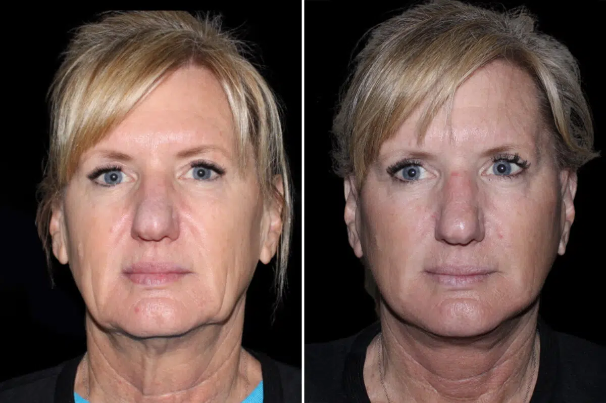 Patient 3814, Facelift & Necklift Before and After Photos Facelift & Necklift Before and After Photos in CA, Irvine, Patient 3814