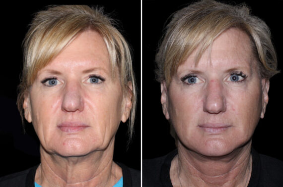 Facelift & Necklift Before and After Photos in CA, Irvine, Patient 3814
