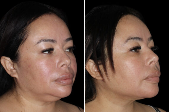 Facelift & Necklift Before and After Photos in CA, Irvine, Patient 3989