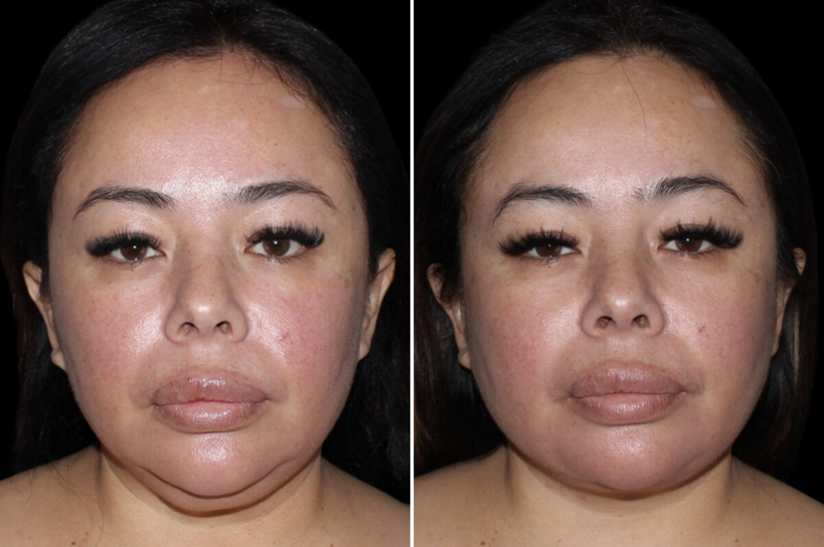 Facelift & Necklift Before and After Photos in CA, Irvine, Patient 3989