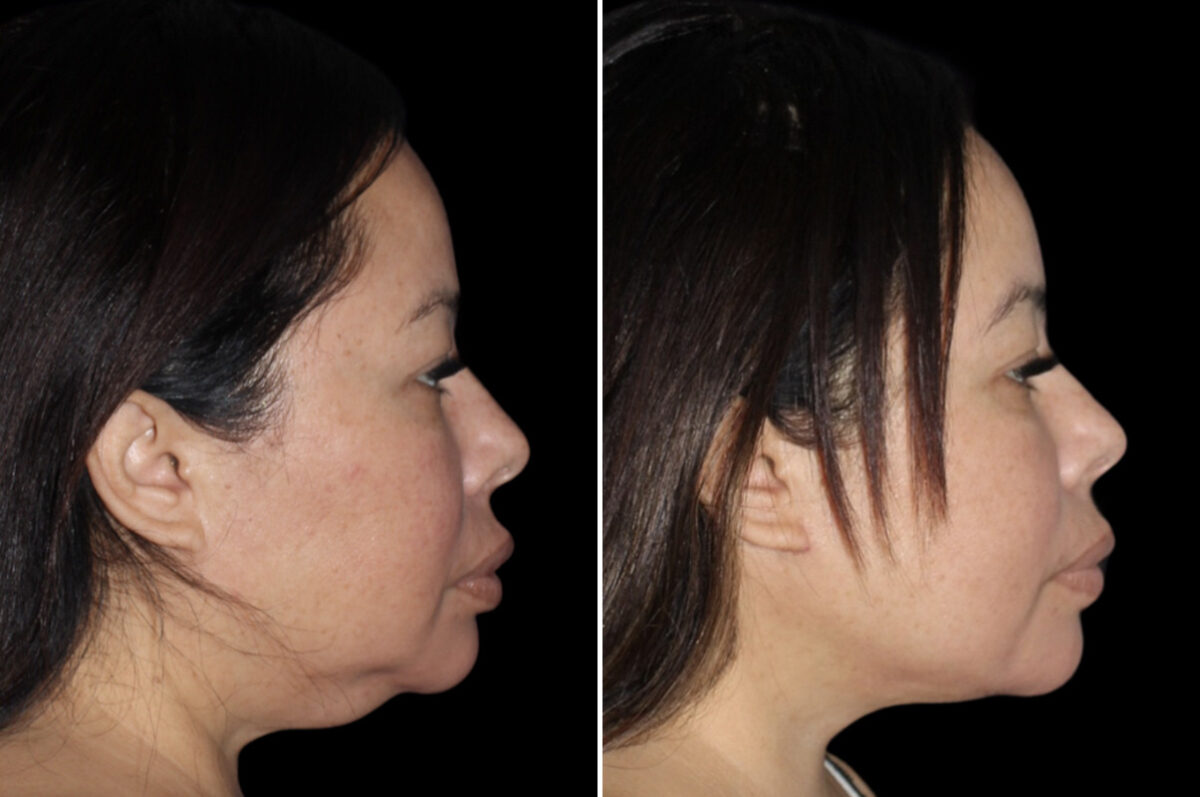 Facelift & Necklift Before and After Photos in CA, Irvine, Patient 3989