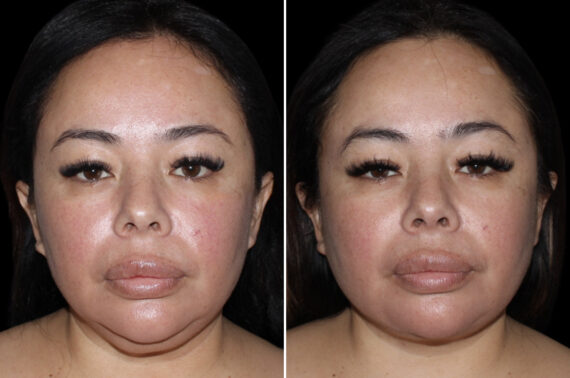 Facelift & Necklift Before and After Photos in CA, Irvine, Patient 3989