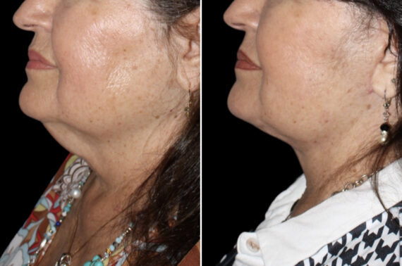 Facelift & Necklift Before and After Photos in CA, Irvine, Patient 3999