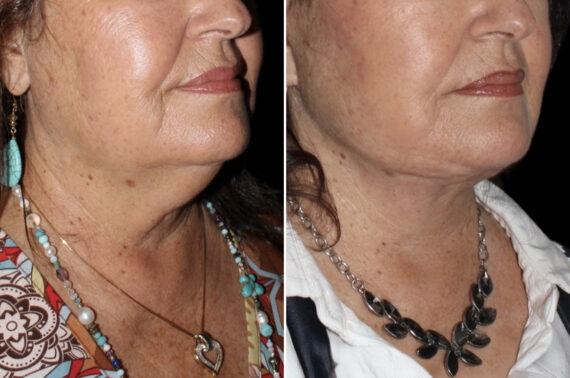 Facelift & Necklift Before and After Photos in CA, Irvine, Patient 3999