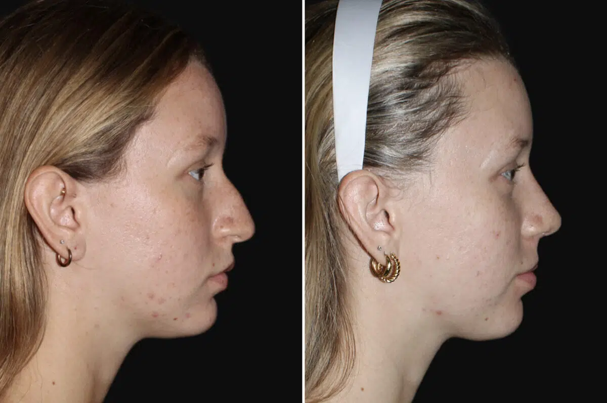 Rhinoplasty Before and After Photos in CA, Irvine, Patient 4006