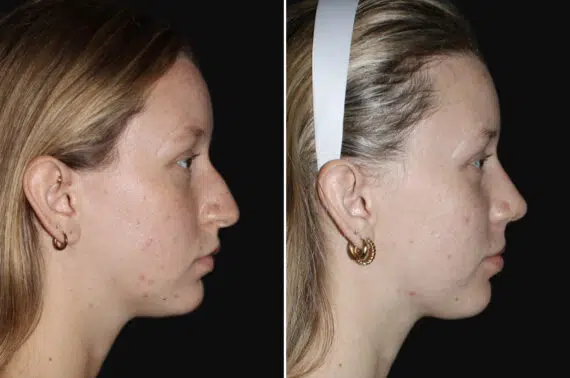 Rhinoplasty Before and After Photos in CA, Irvine, Patient 4006