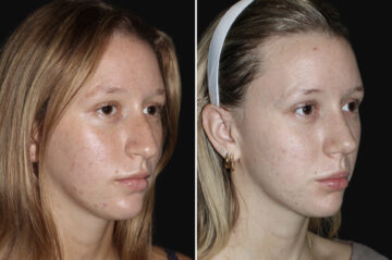 Rhinoplasty Before and After Photos in CA, Irvine, Patient 4006
