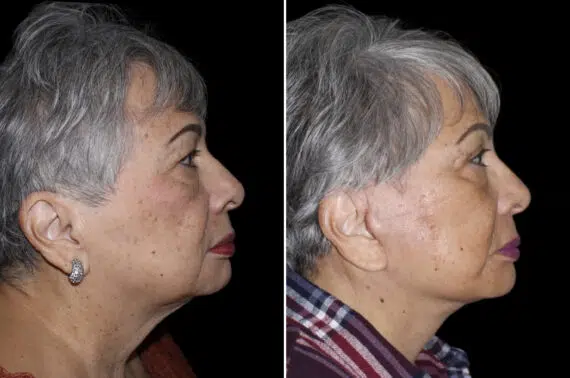 Facelift & Necklift Before and After Photos in CA, Irvine, Patient 4013