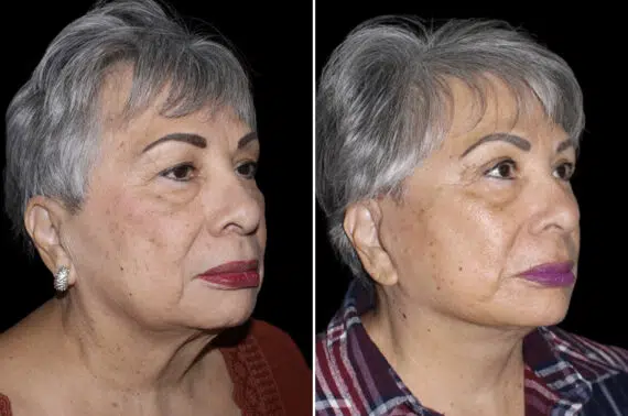 Facelift & Necklift Before and After Photos in CA, Irvine, Patient 4013
