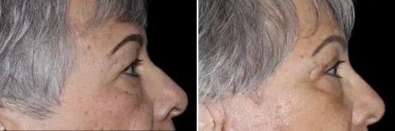 Blepharoplasty Before and After Photos in CA, Irvine, Patient 4021