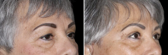 Blepharoplasty Before and After Photos in CA, Irvine, Patient 4021