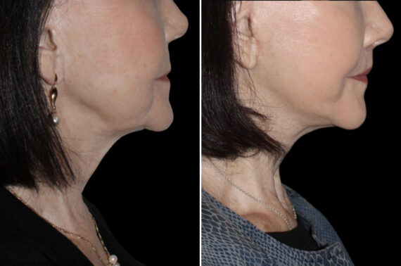 Mini Lift Before and After Photos in CA, Irvine, Patient 4028
