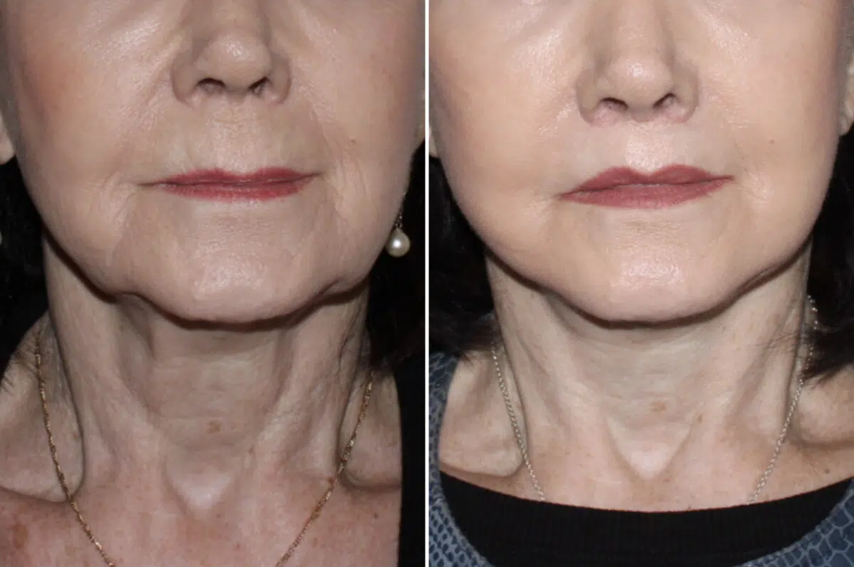 Mini Lift Before and After Photos in CA, Irvine, Patient 4028