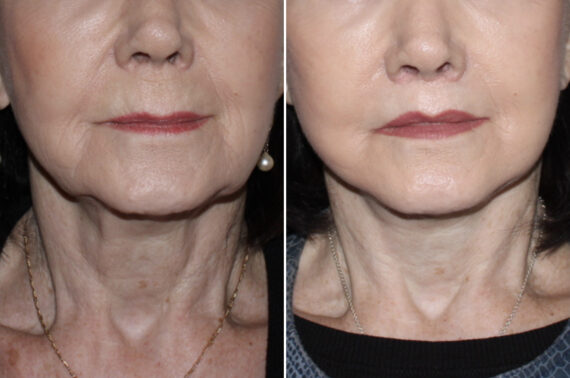 Mini Lift Before and After Photos in CA, Irvine, Patient 4028