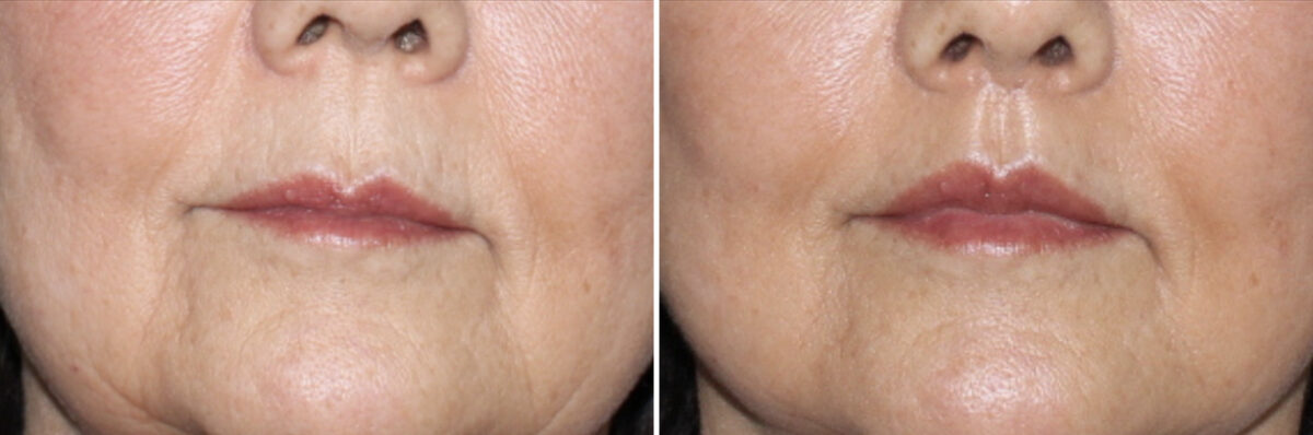 Lip Lift Before and After Photos in CA, Irvine, Patient 4035