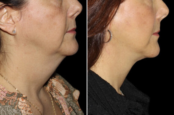 Facelift & Necklift Before and After Photos in CA, Irvine, Patient 4042