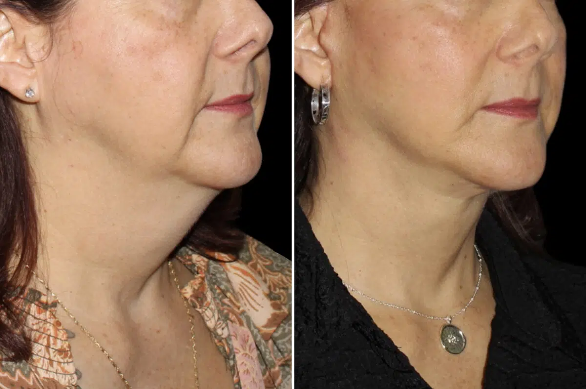Patient 4042, Facelift & Necklift Before and After Photos Facelift & Necklift Before and After Photos in CA, Irvine, Patient 4042