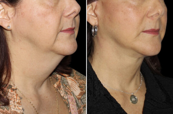 Facelift & Necklift Before and After Photos in CA, Irvine, Patient 4042